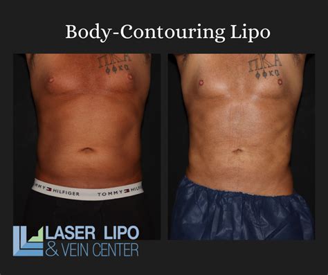 liposuction cost st louis|Liposuction – St. Louis, MO & Glen Carbon, IL – MidAmerica。